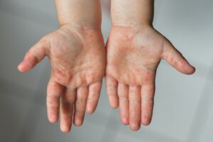 Kes HFMD terus meningkat di seluruh negara